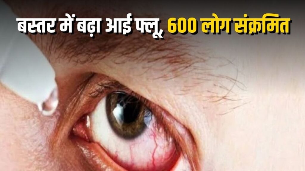 CG Eye Flu : छत्तीसगढ़ में आई फ्लू का बढ़ता खतरा, बस्तर में 600 से ज्यादा केस; जानें लक्षण और बचाव